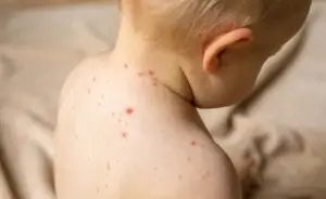 ما هو الجدرى المائي – الاعراض والاسباب والعلاج