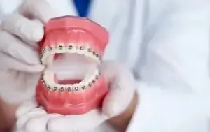 أنواع تقويم الأسنان ومتى تحتاجه والمراحل والنصائح